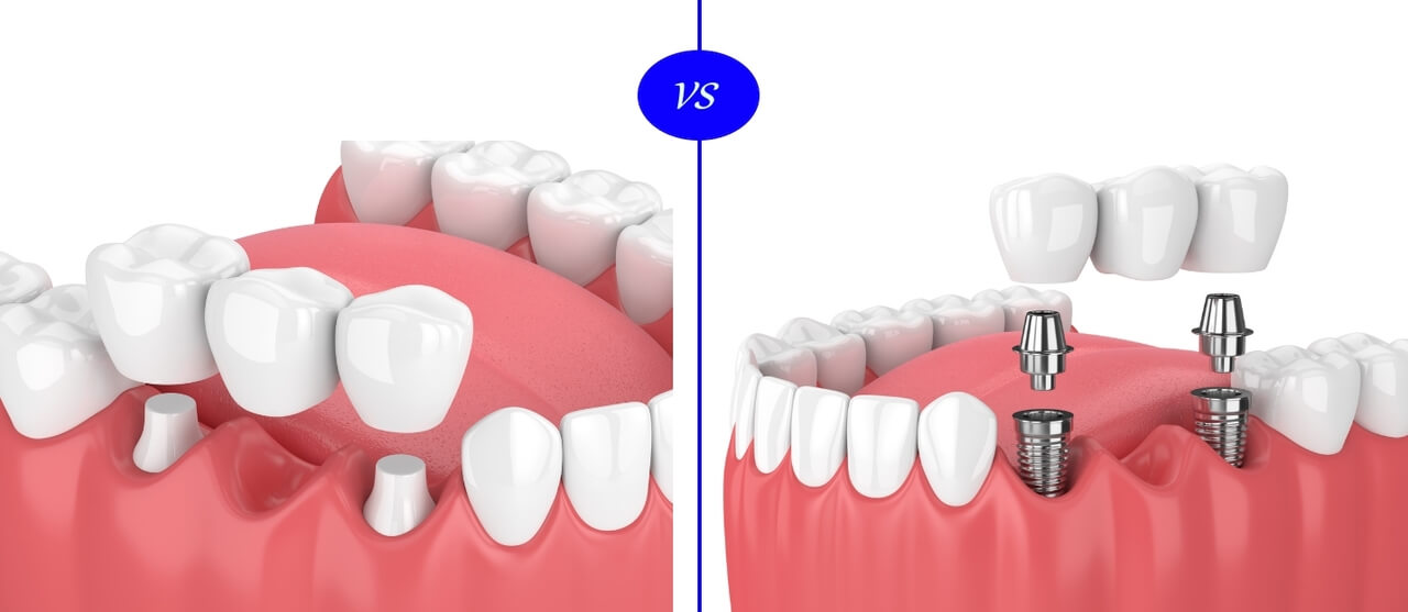 Implantes Dentales o Puentes Dentales: ¿Qué es mejor para mí?