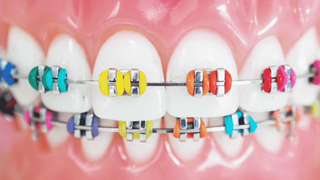 BRACKETS ¿Qué son y para qué sirven?