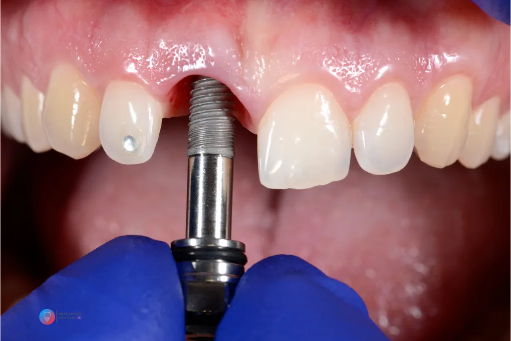 6 beneficios de los implantes dentales que transformarán tu sonrisa