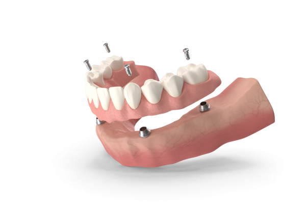 Implant Supported Denture.H03.2k
