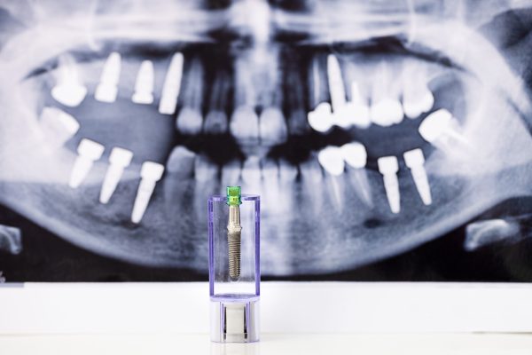 dental-implant-and-x-ray-picture-as-background-2026-01-07-06-35-23-utc